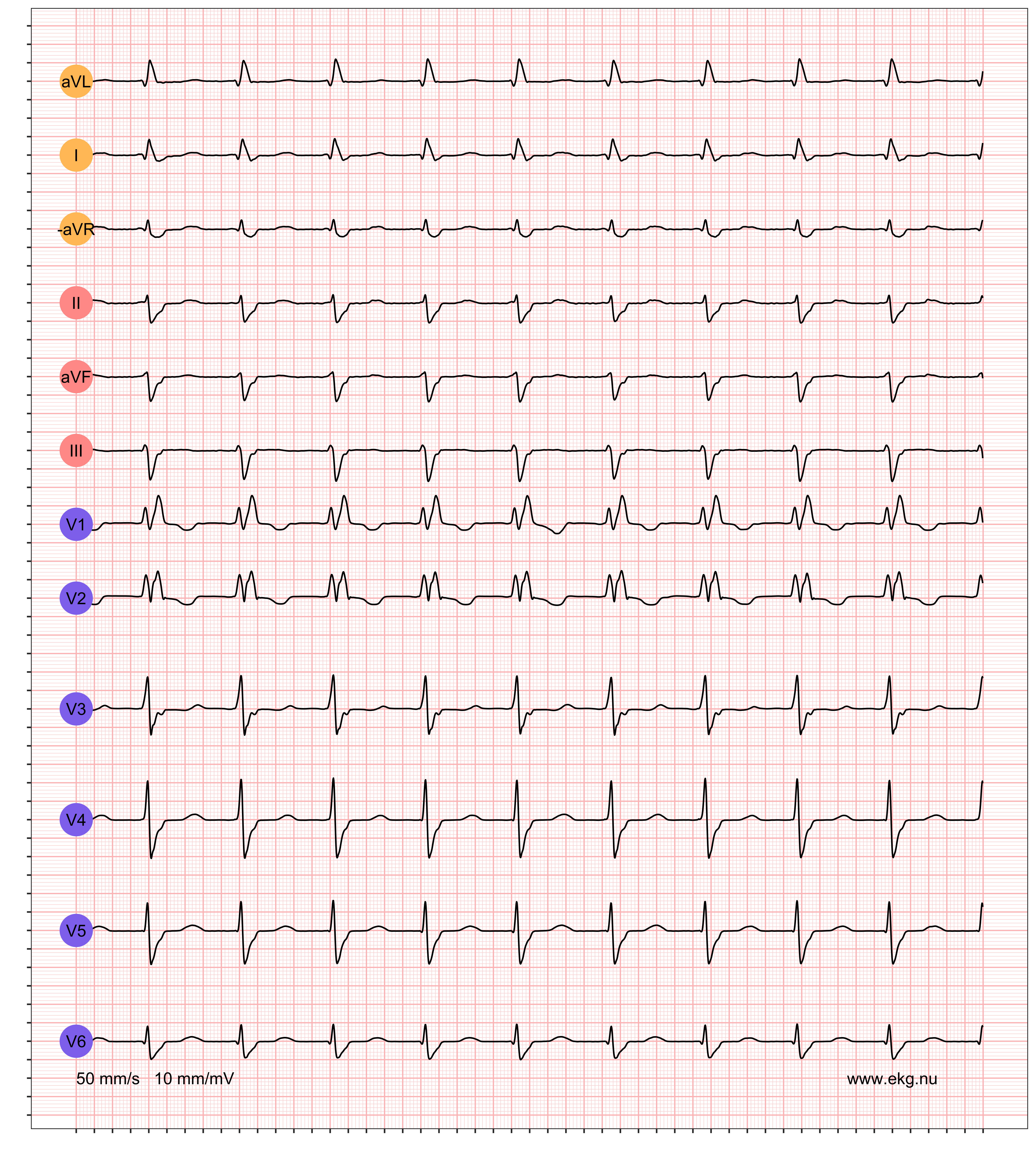 EKG-remsa: AF · AVB · LFBBB · RBBB