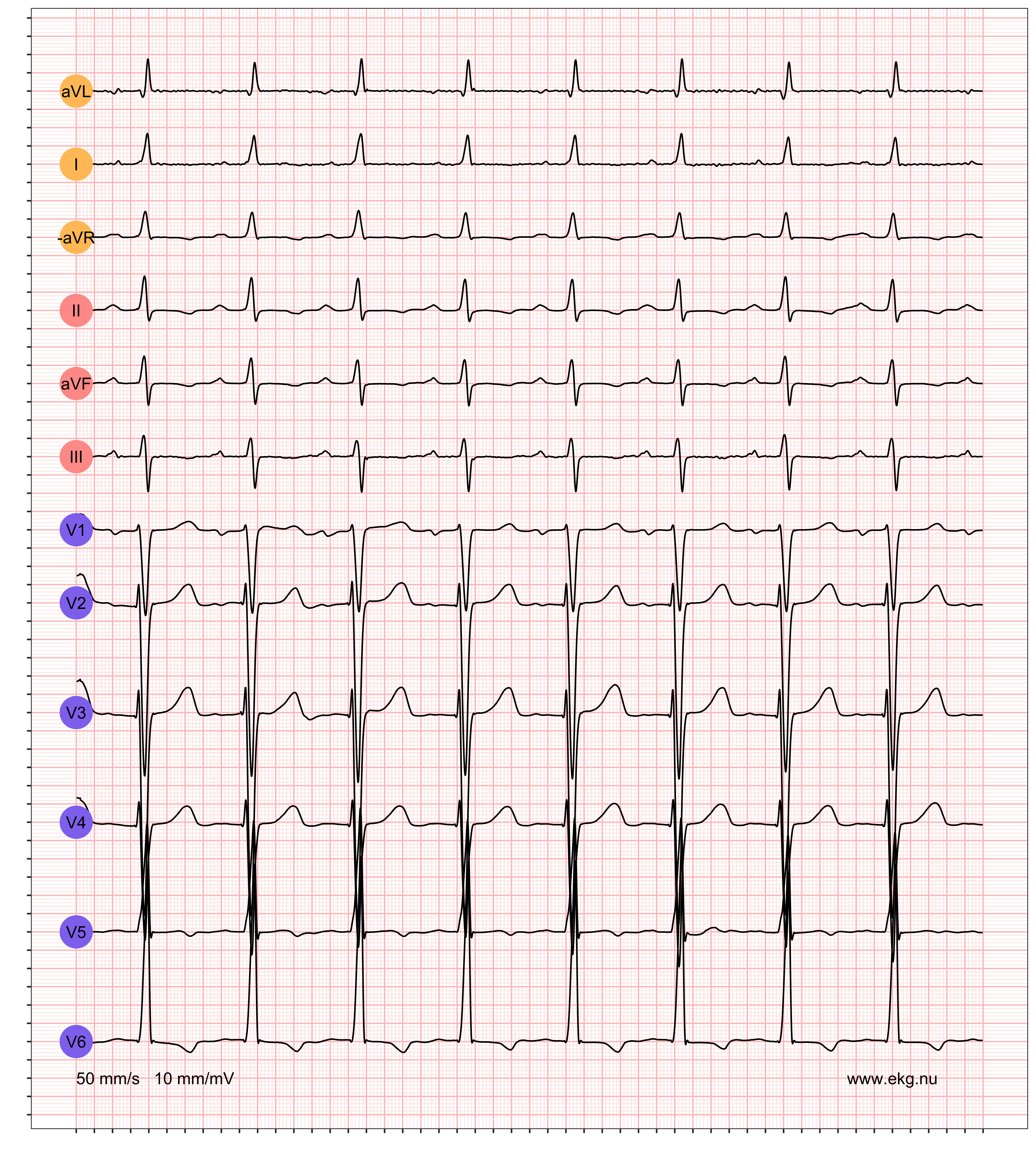 EKG-remsa: ST · LVHV · PWC
