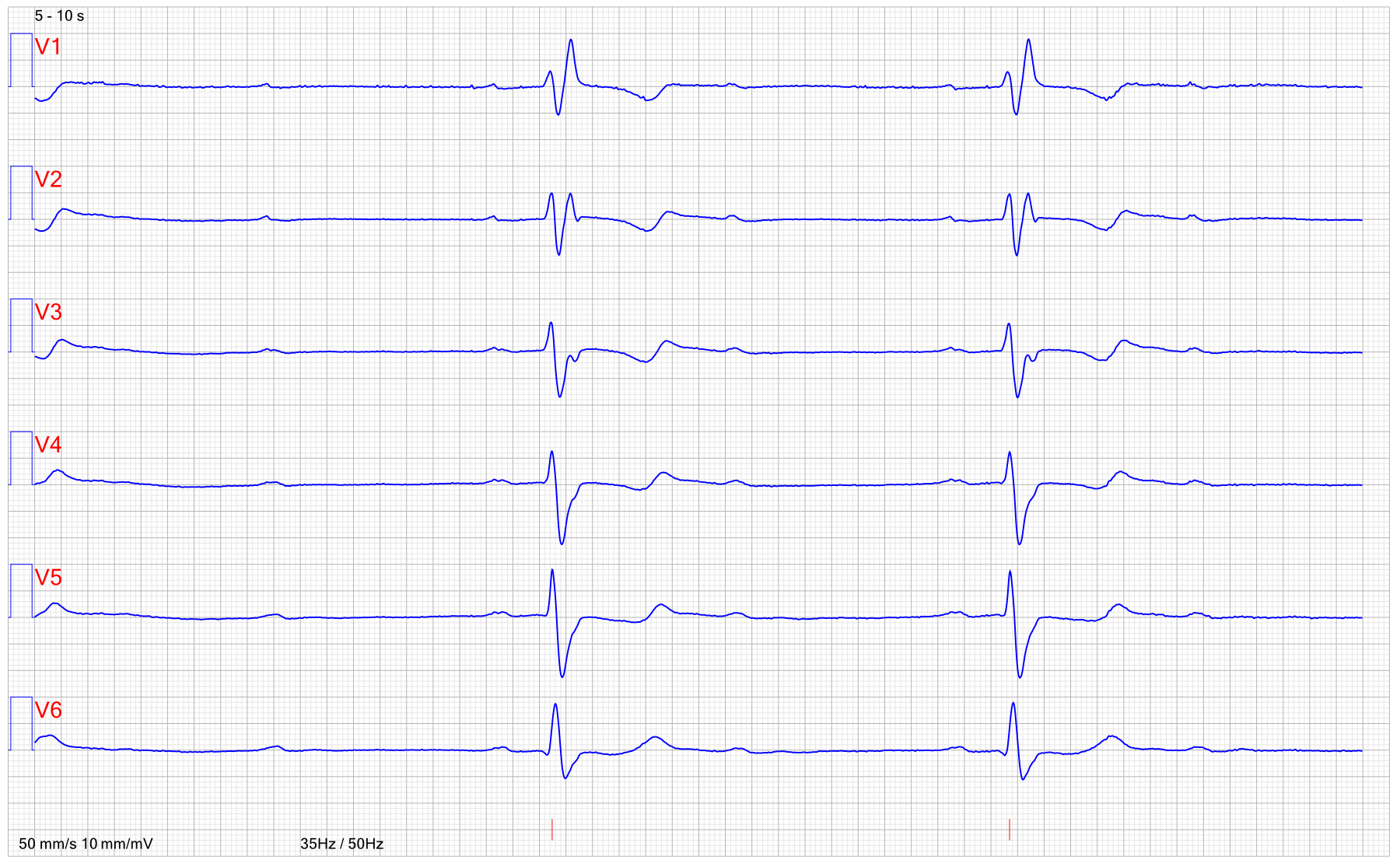 EKG AV block 3 2