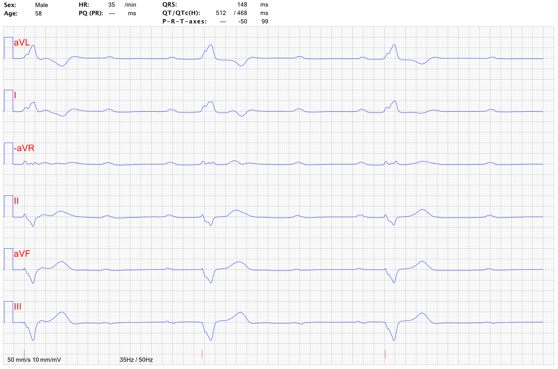 EKG AV block 3 falltrauma 1