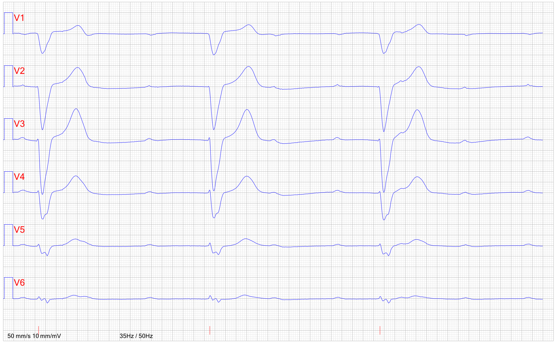EKG AV block 3 falltrauma 2