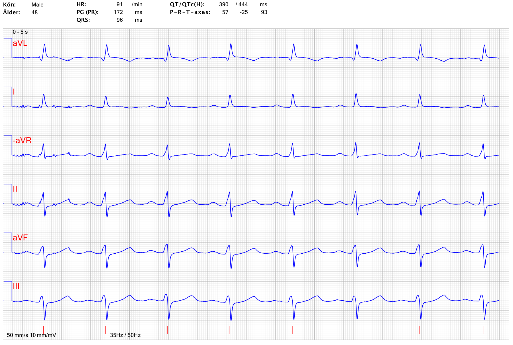 EKG STEMI anterior ST hojningsinfarkt 1
