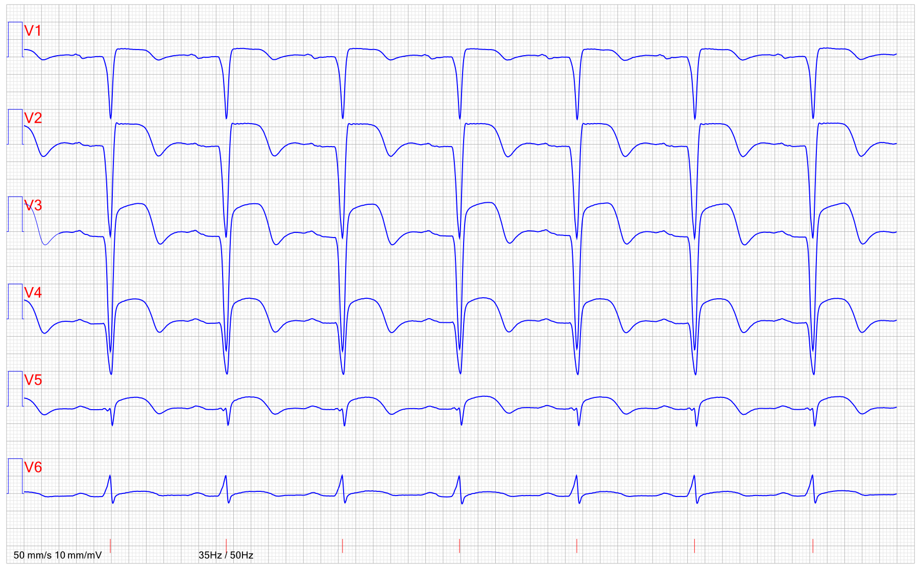 EKG STEMI anterior ST hojningsinfarkt 2