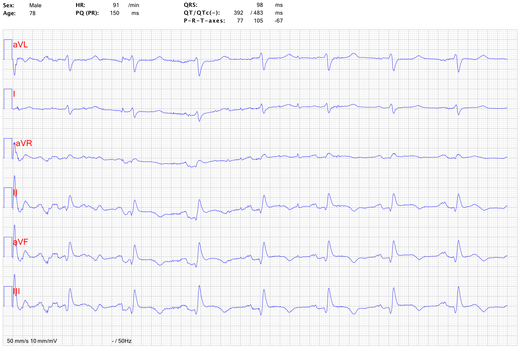 EKG STEMI hjartstopp 1