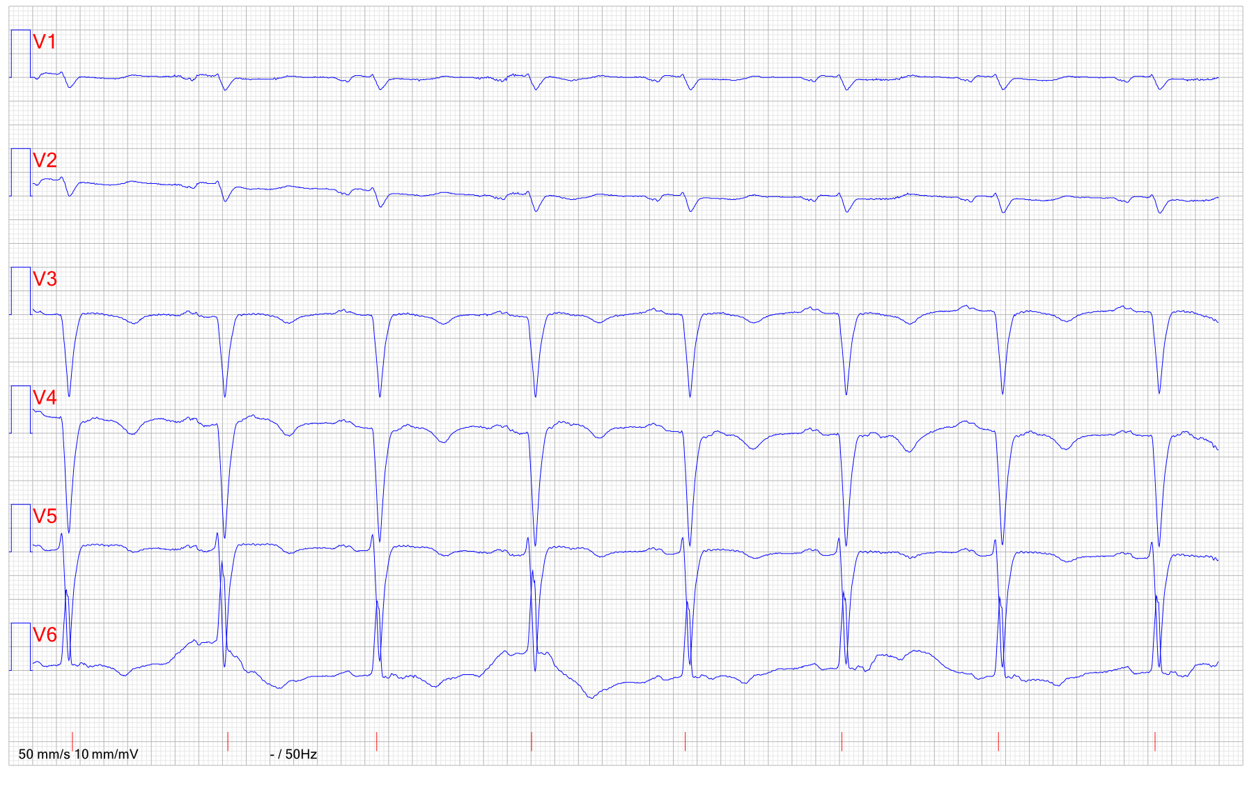 EKG STEMI hjartstopp 2