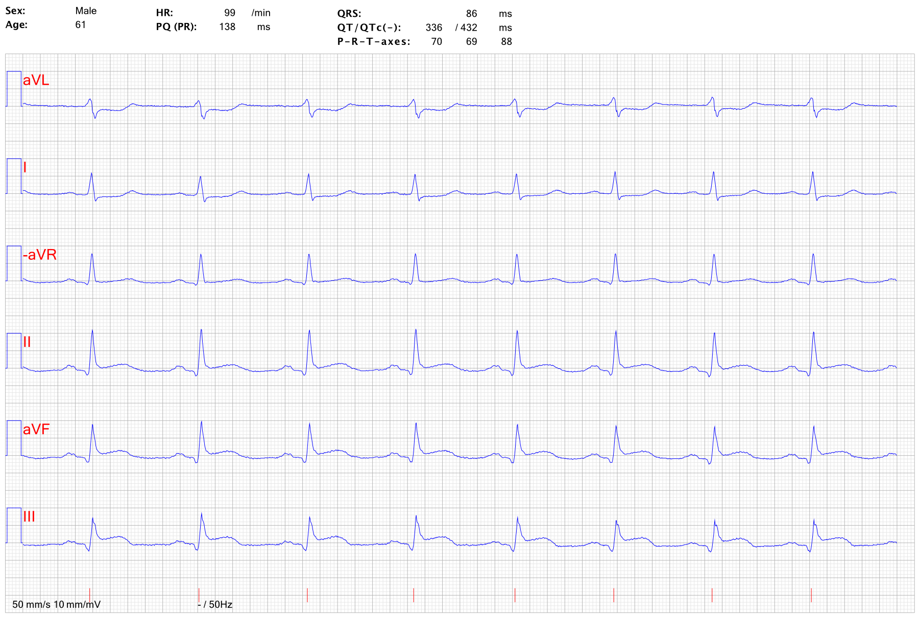 EKG STEMI inferoposterior 1