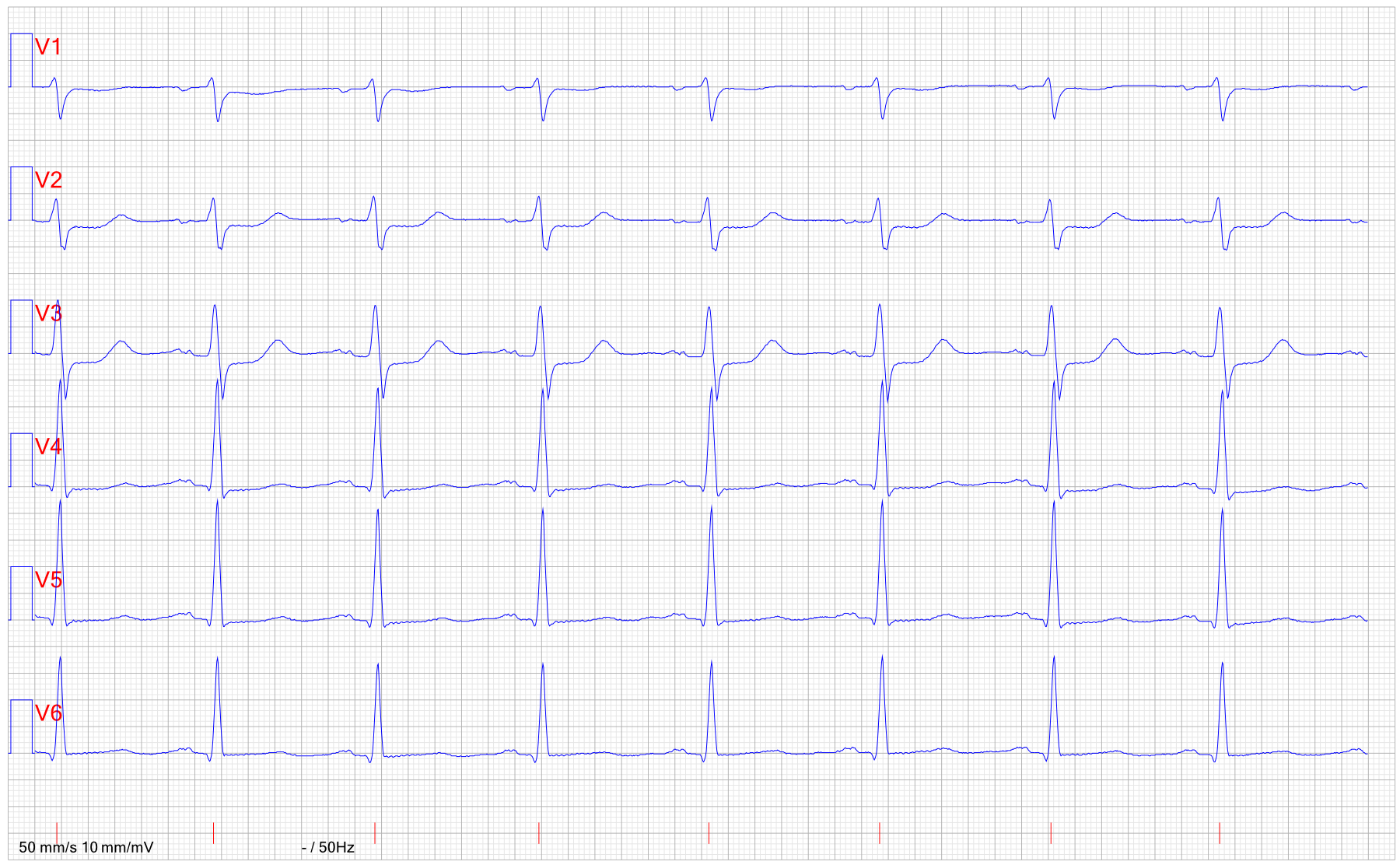 EKG STEMI inferoposterior 2
