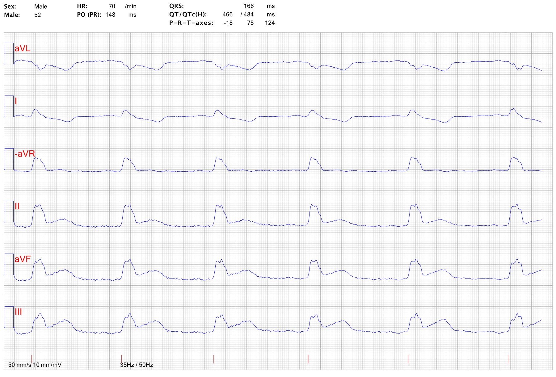 EKG STEMI pa LBBB 1