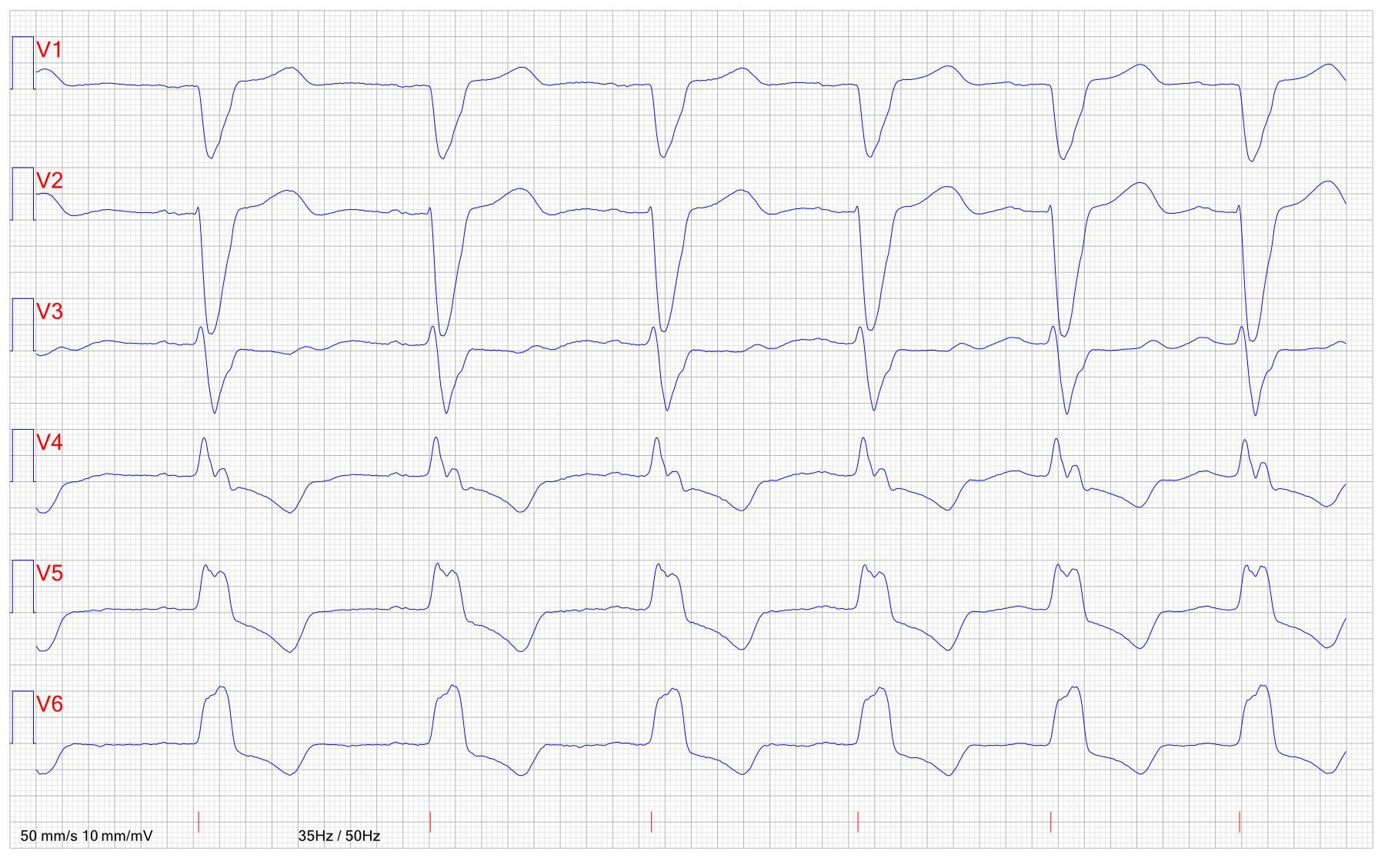 EKG STEMI pa LBBB 2