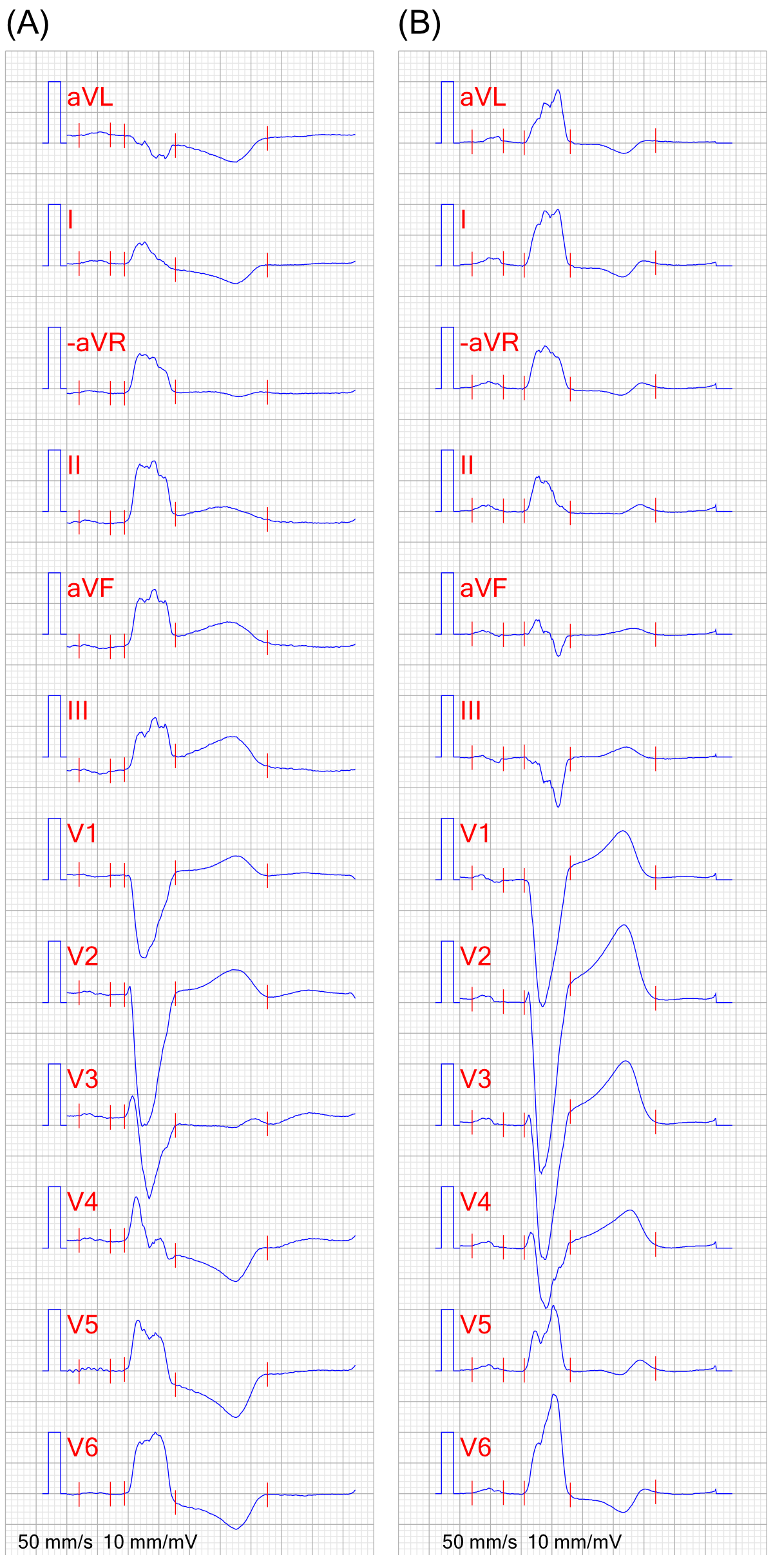 EKG STEMI pa LBBB 3 1