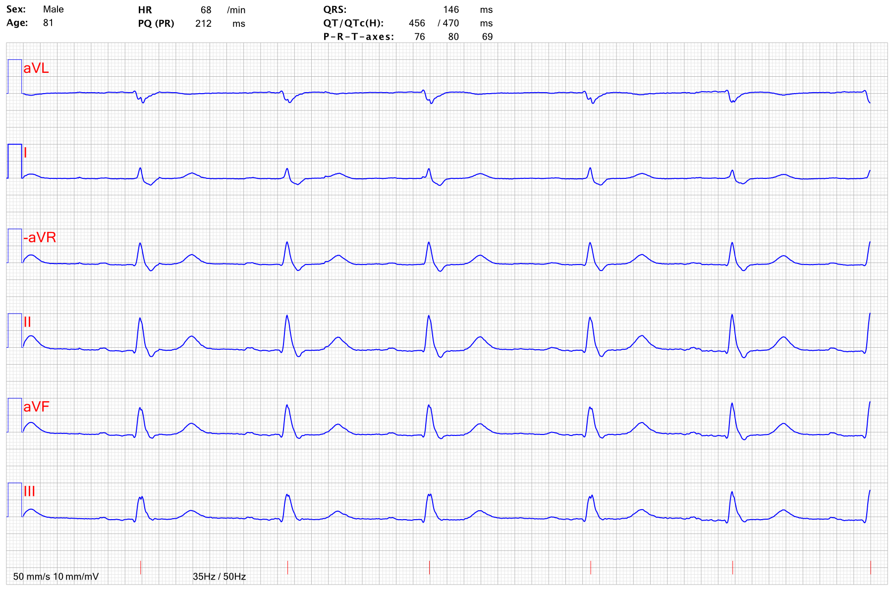 EKG AV block 1 hogergrenblock RBBB 1