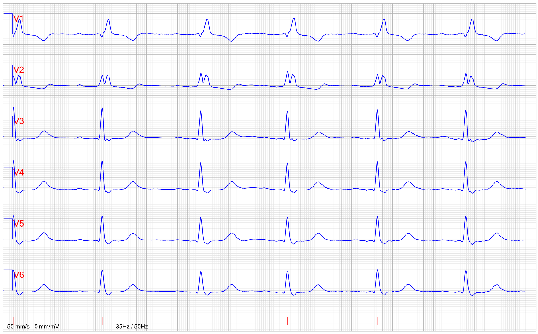 EKG AV block 1 hogergrenblock RBBB 2