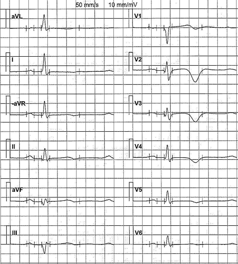 EKG-test 1, bild 10