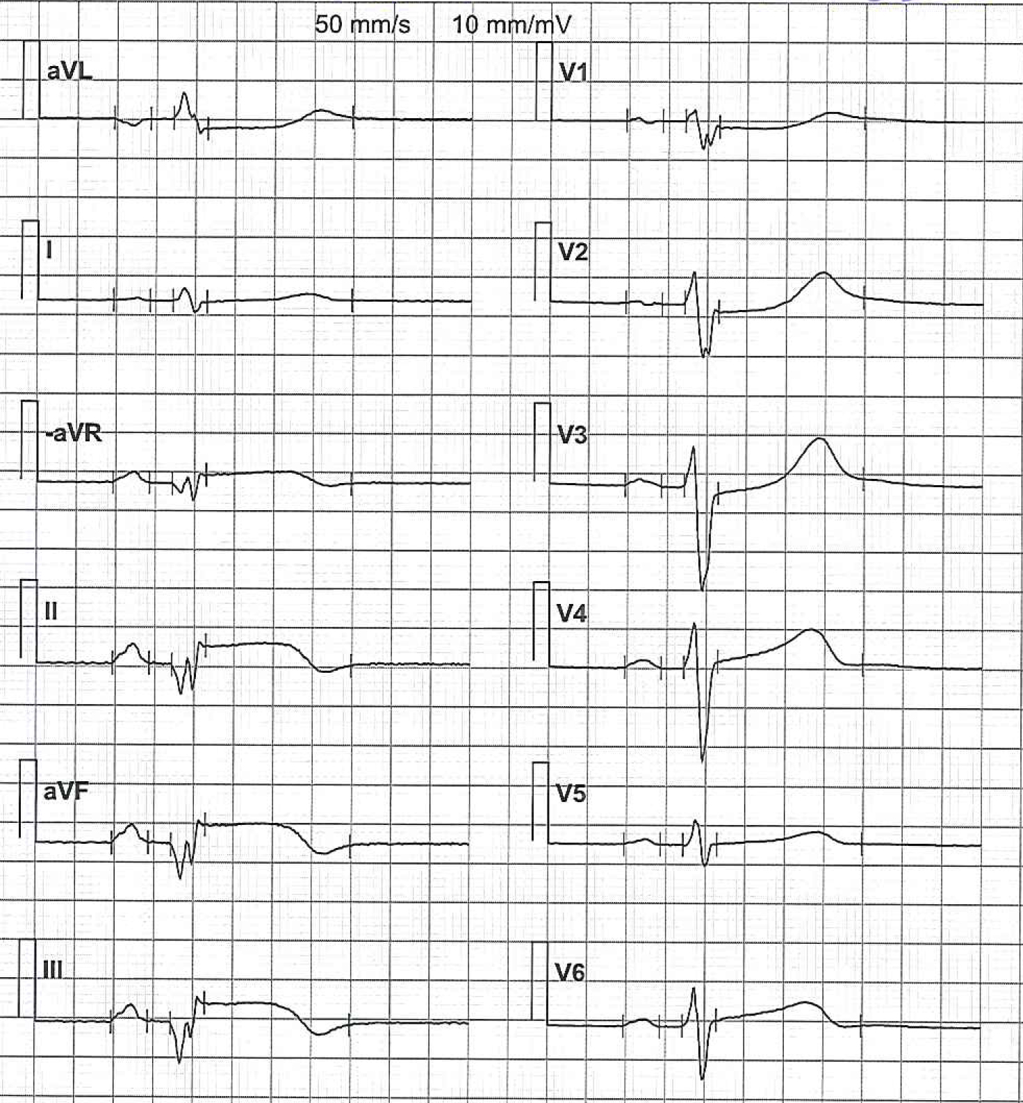 EKG-test 1, bild 11