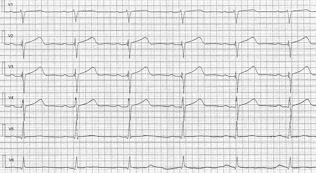 EKG-test 1, bild 2
