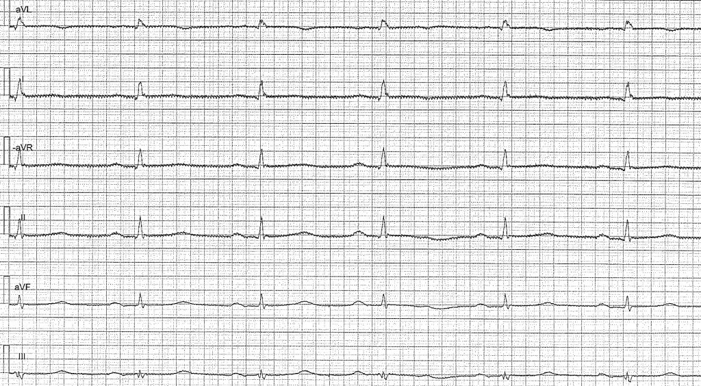 EKG-test 1, bild 2