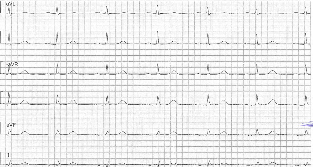 EKG-test 1, bild 4