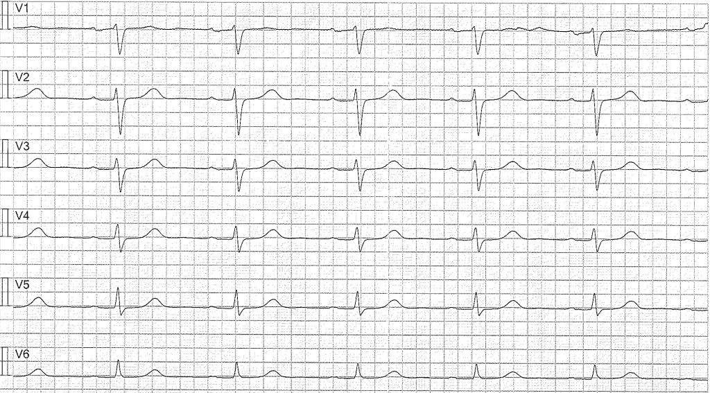 EKG-test 1, bild 4