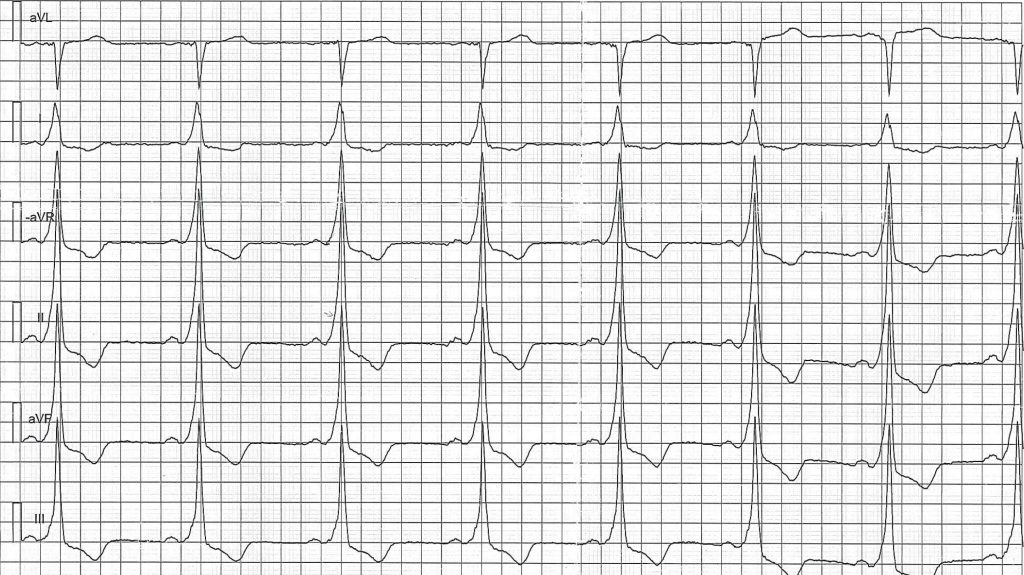 EKG-test 1, bild 5