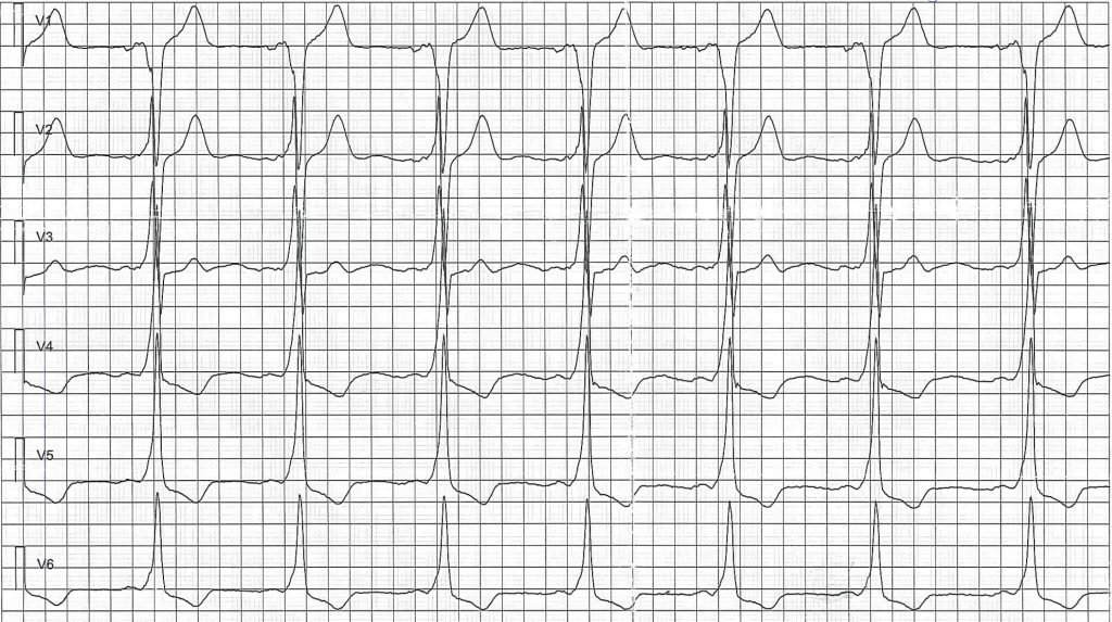 EKG-test 1, bild 5