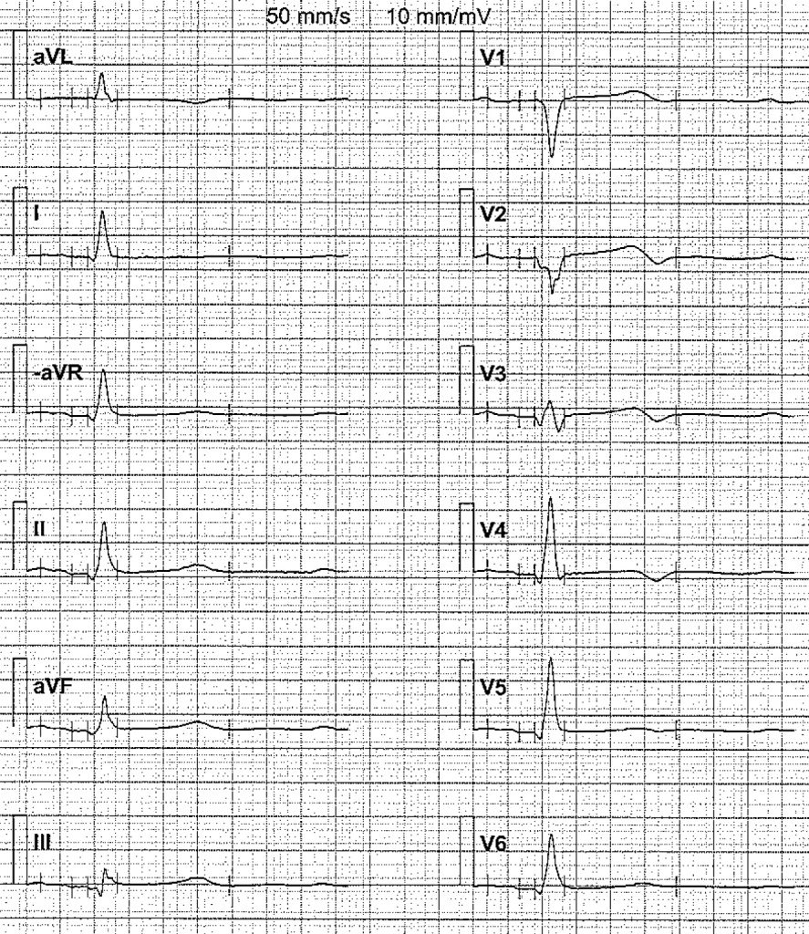 EKG-test 1, bild 6