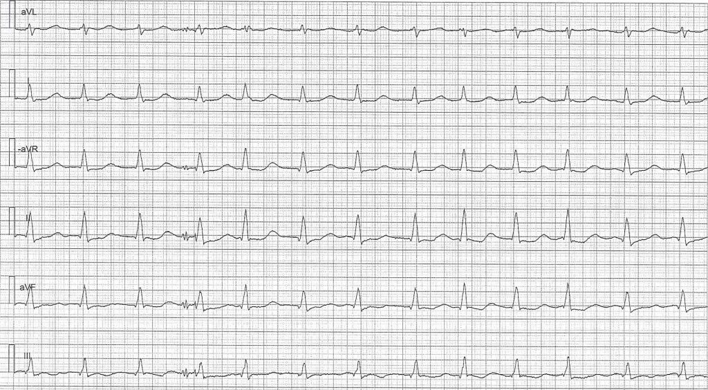 EKG-test 1, bild 7