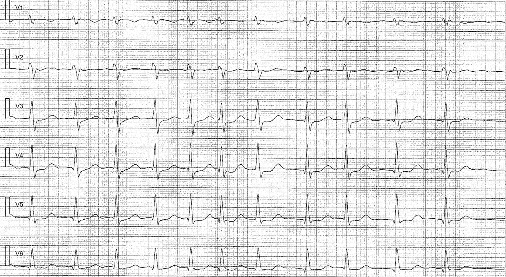 EKG-test 1, bild 7