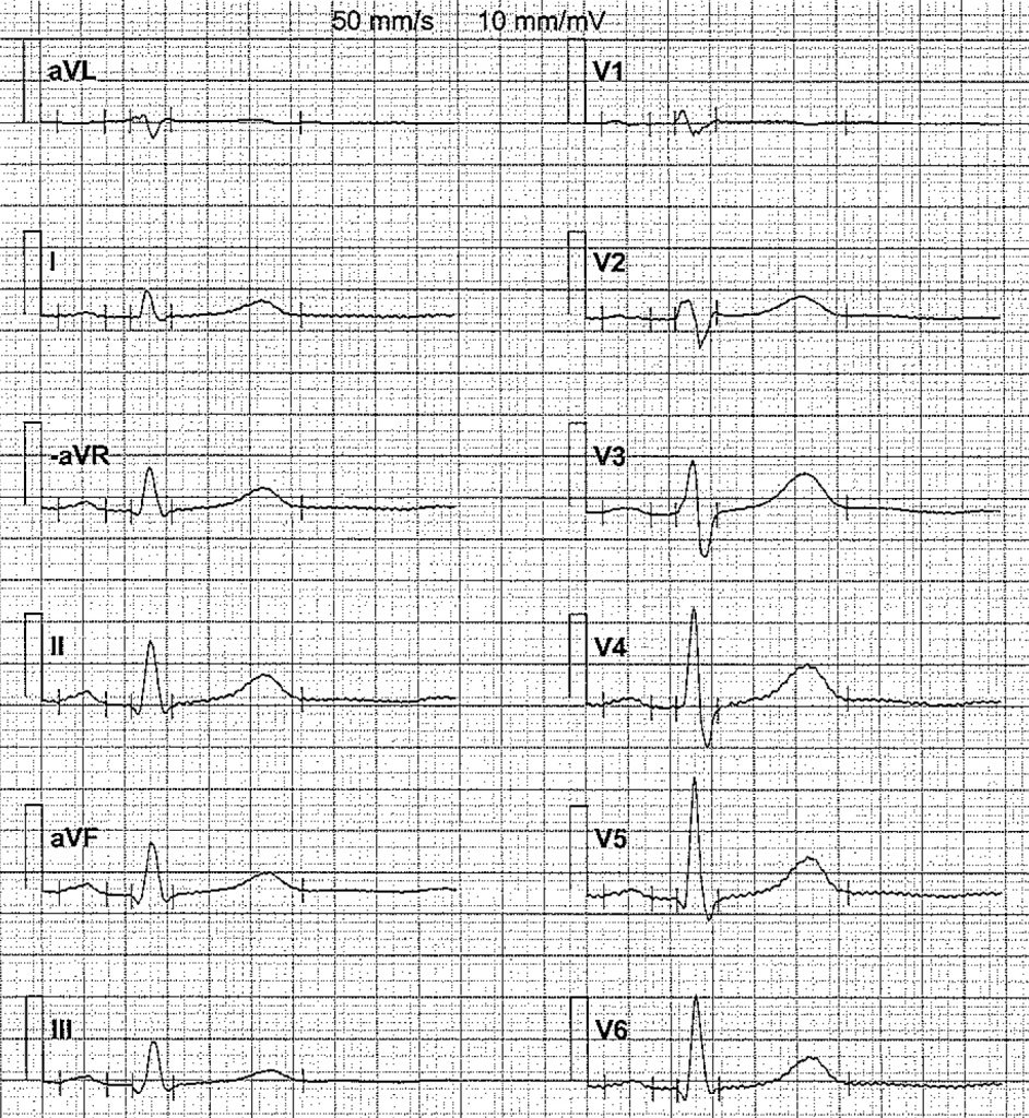 EKG-test 1, bild 8