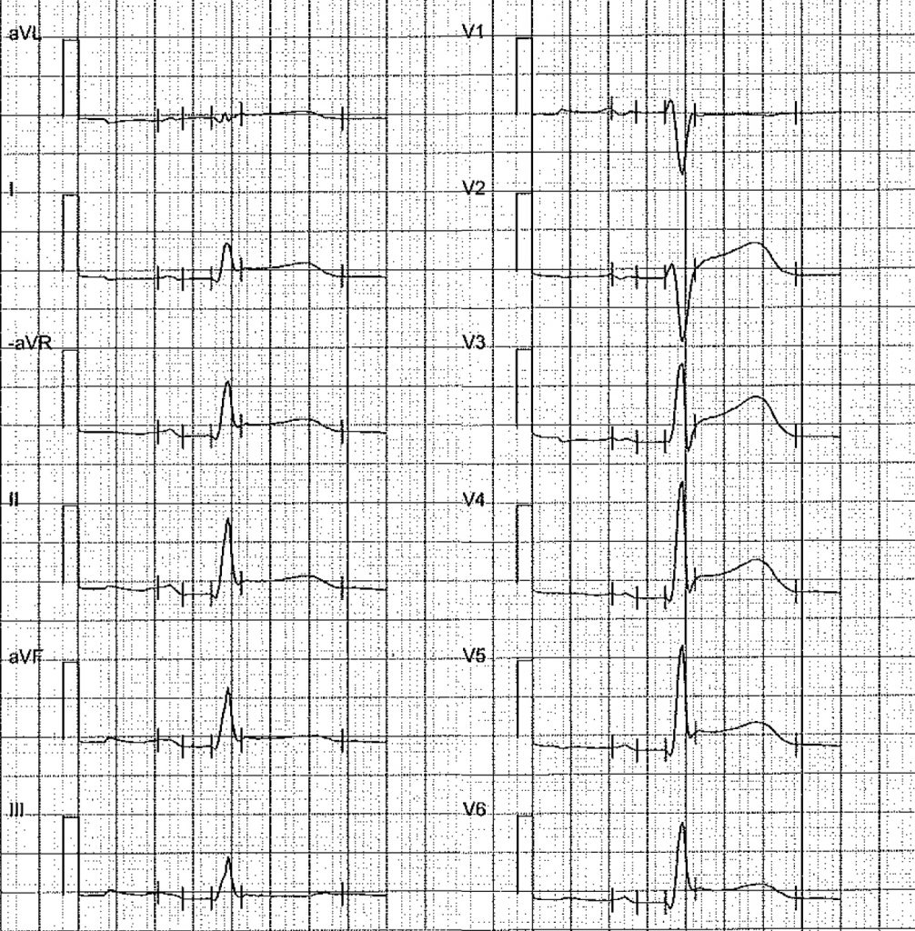 EKG-test 1, bild 9