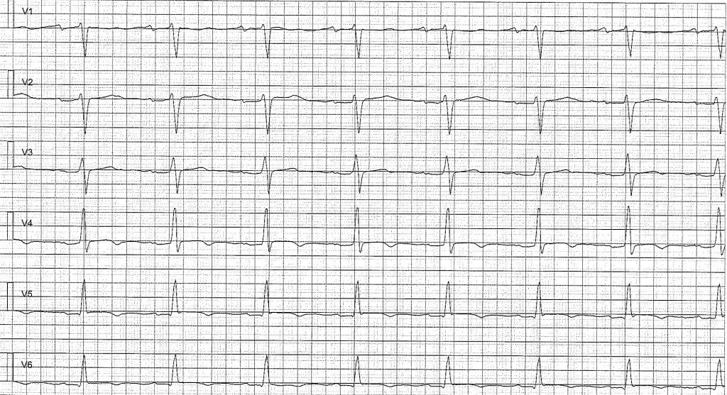 EKG-test 2, bild 1