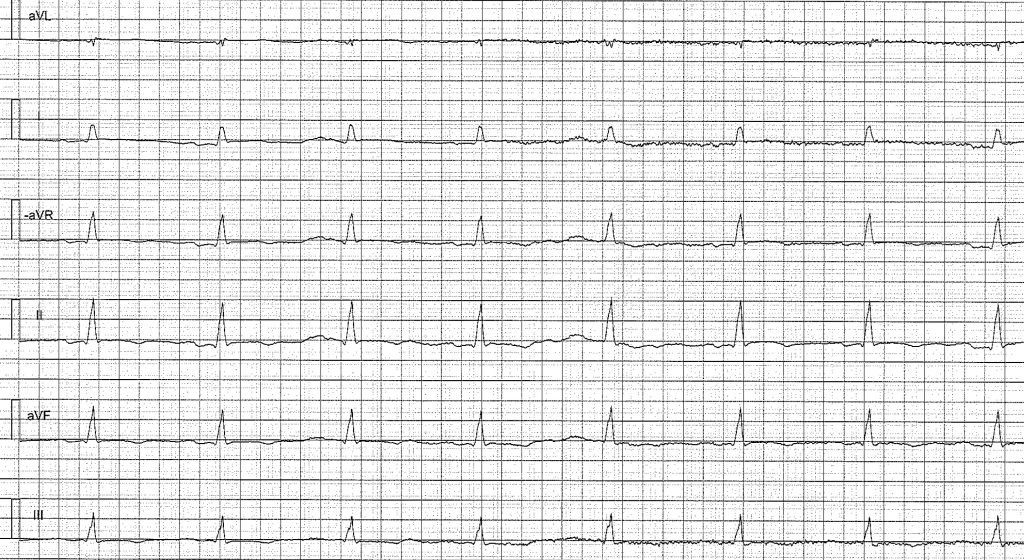EKG-test 2, bild 1