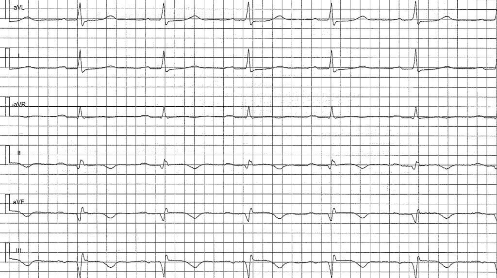 EKG-test 2, bild 2