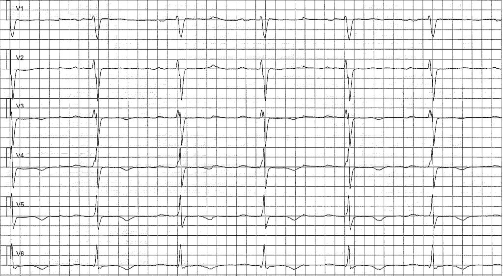EKG-test 2, bild 2