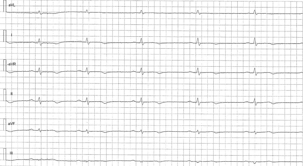 EKG-test 2, bild 3