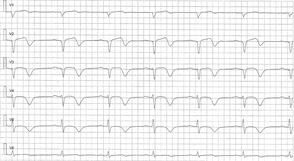 EKG-test 2, bild 3
