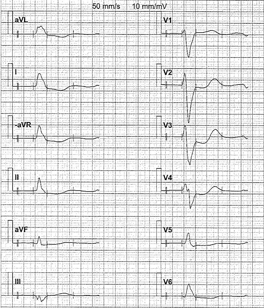 EKG-test 2, bild 5