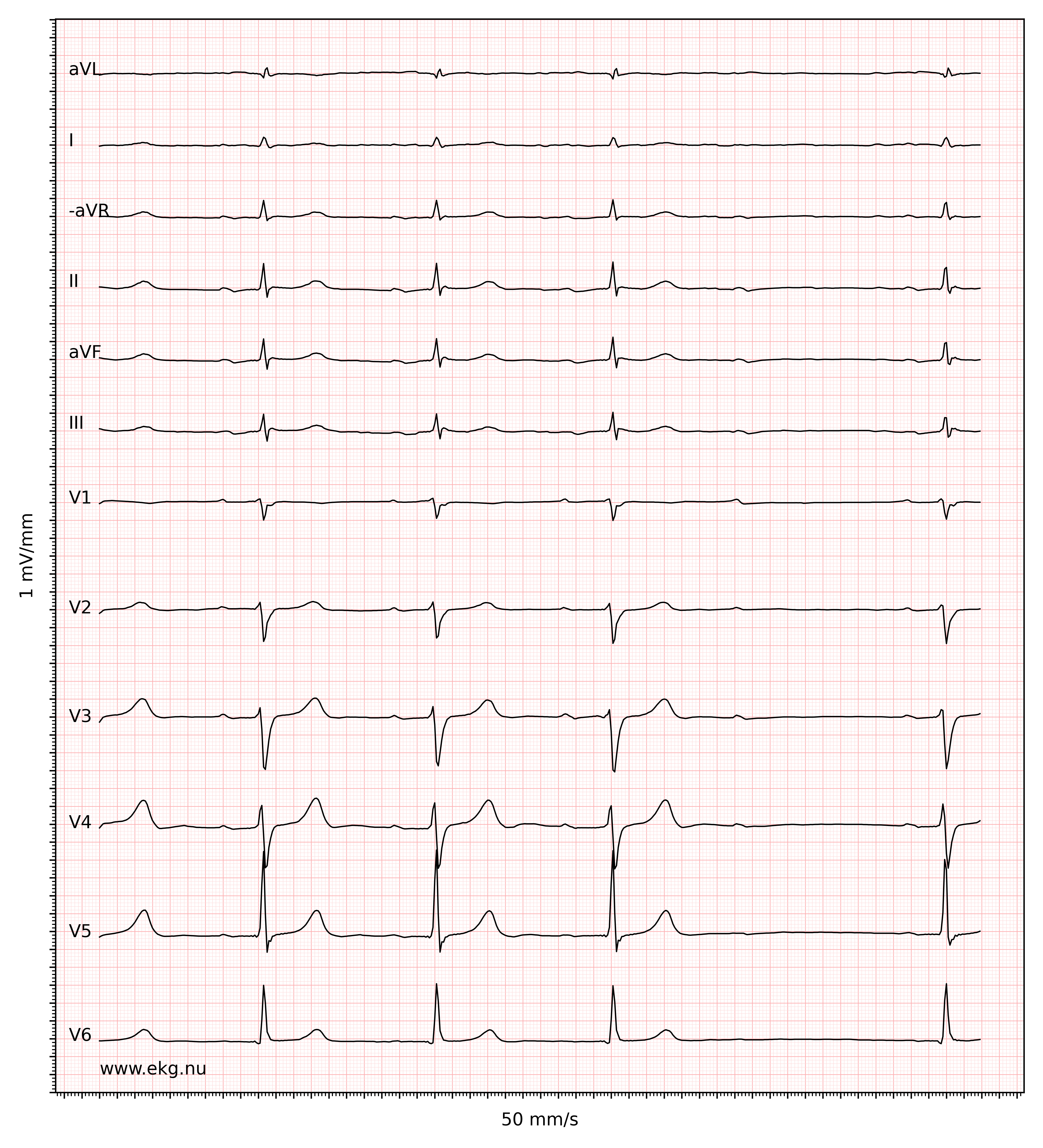 EKG 11208 ecg id 11209 sinus bradycardia normal ecg second degree AV block