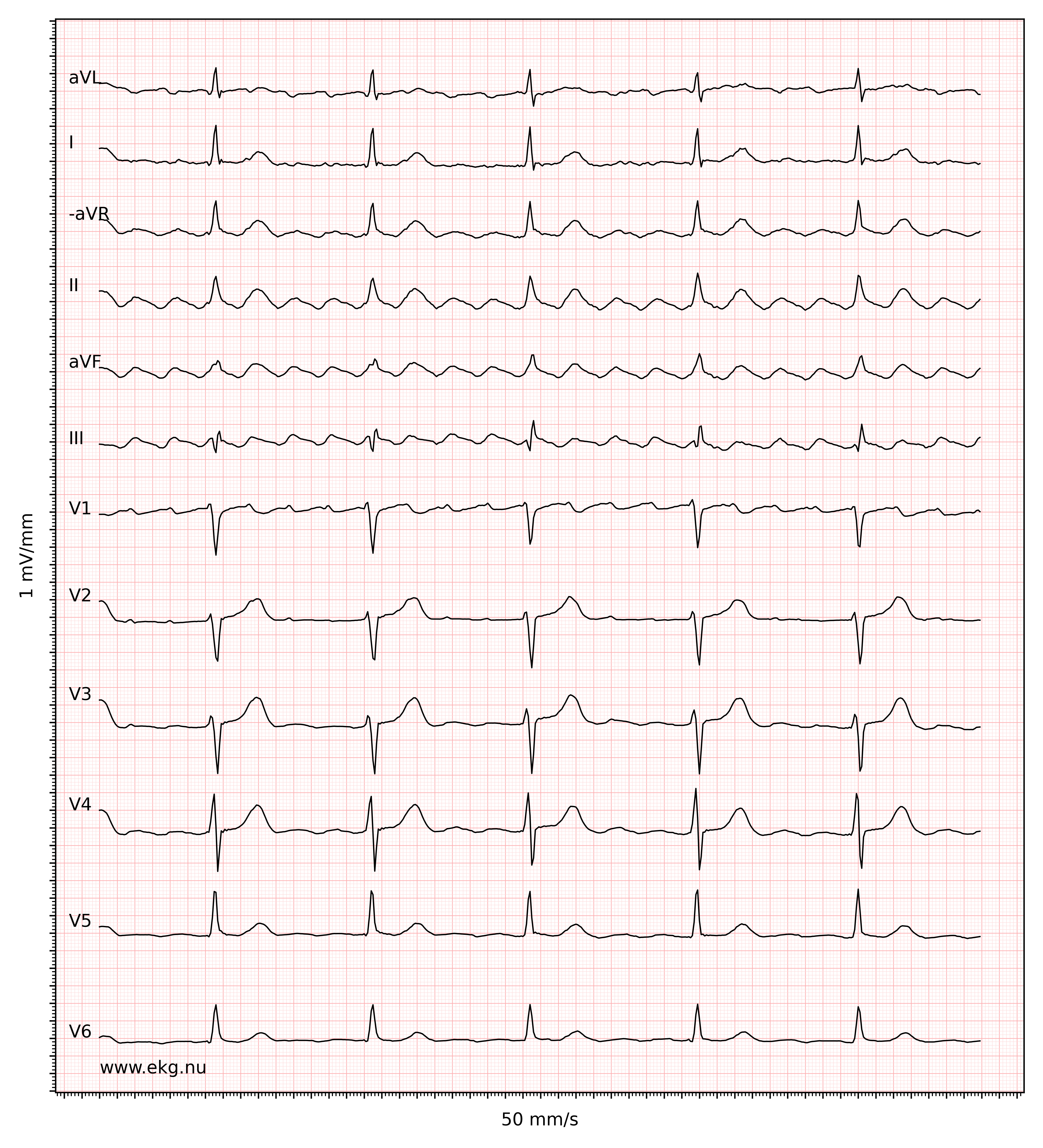 EKG 16400 ecg id 16401 atrial flutter second degree AV block