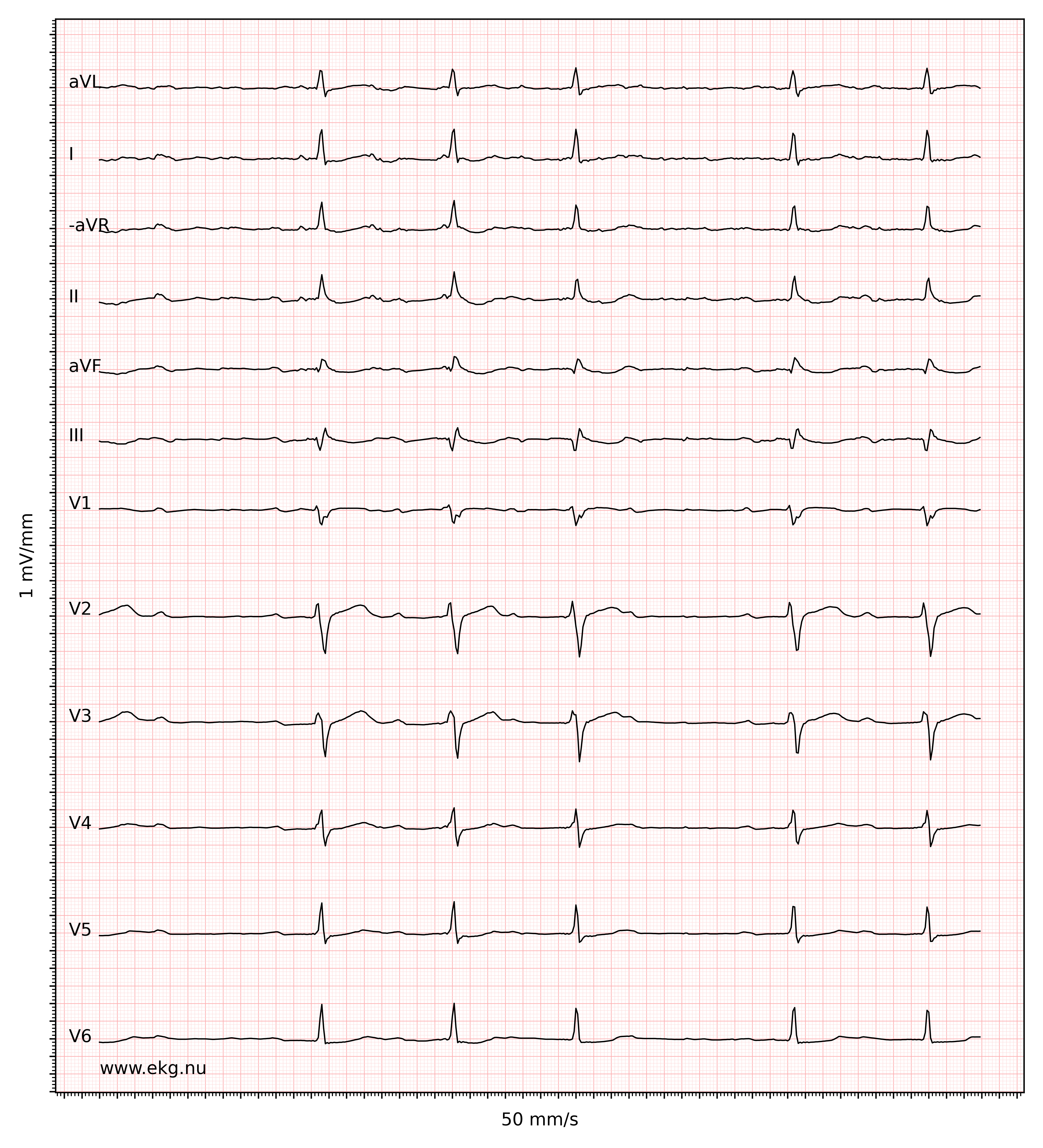 EKG 19163 ecg id 19164 ischemic in inferolateral leads atrial fibrillation second degree AV block