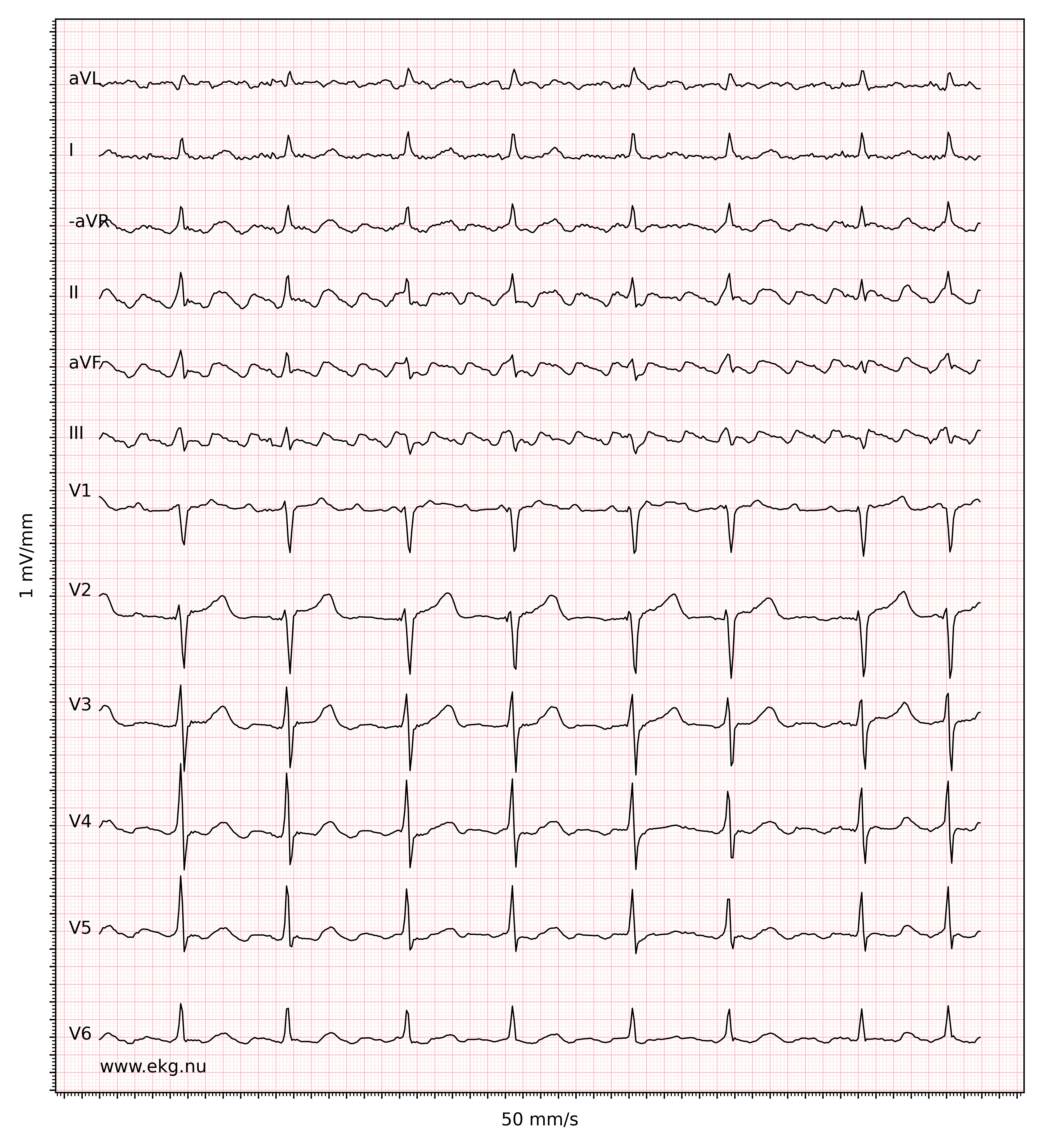 EKG 20084 ecg id 20085 atrial fibrillation atrial flutter