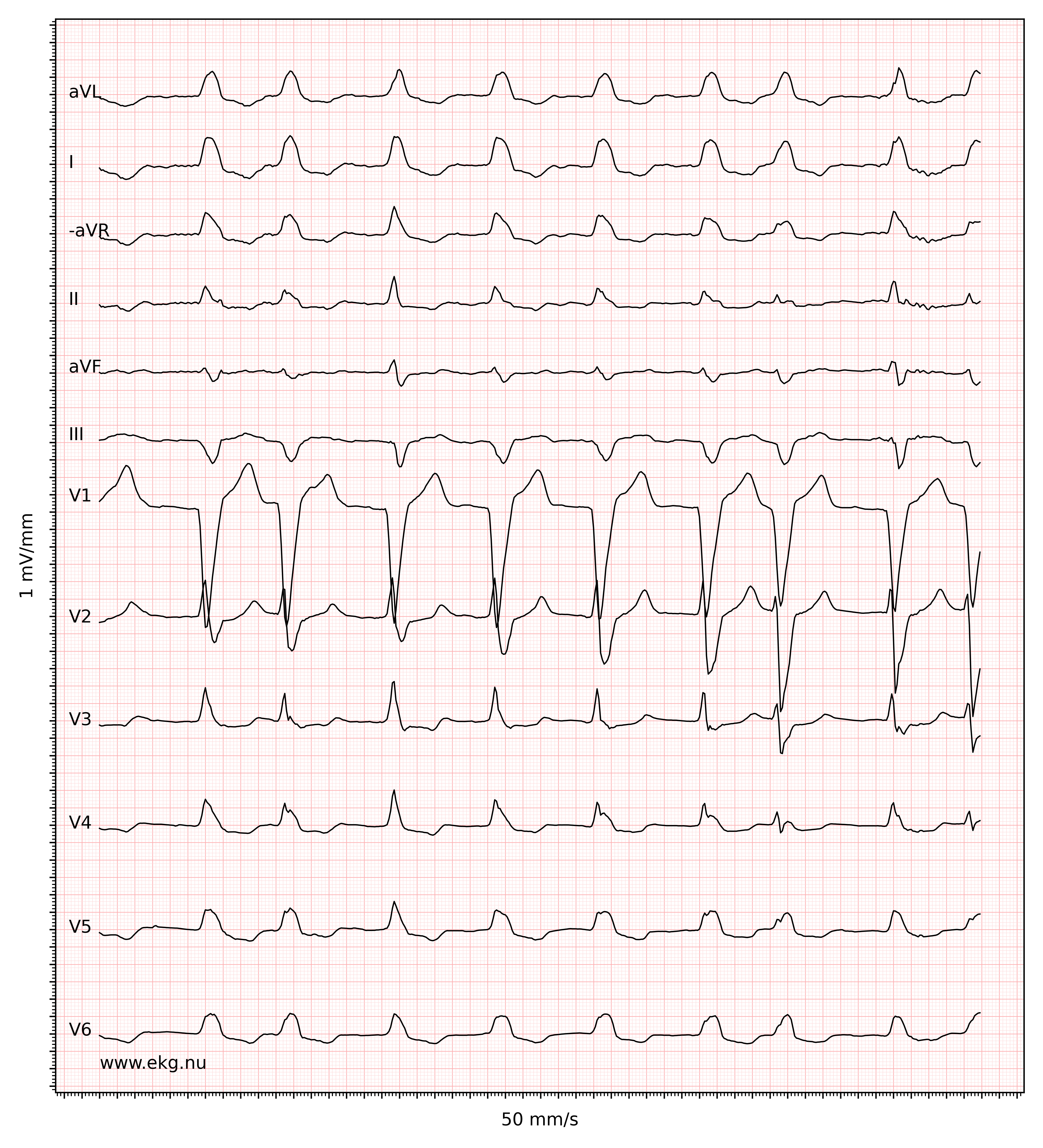 EKG 21760 ecg id 21761 complete left bundle branch block atrial fibrillation