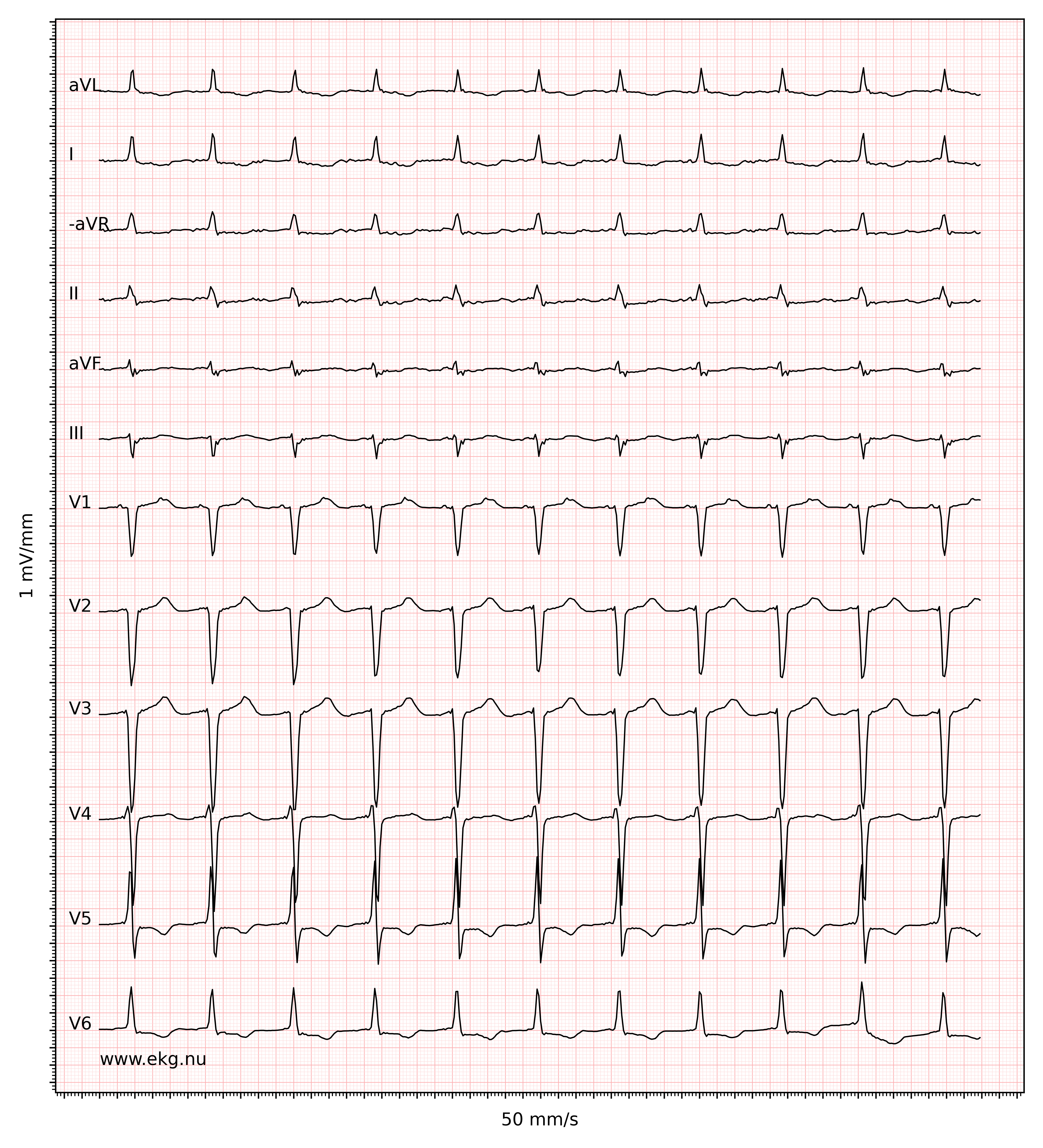 EKG 21780 ecg id 21781 left ventricular hypertrophy abnormal QRS non specific ischemic second degree AV block