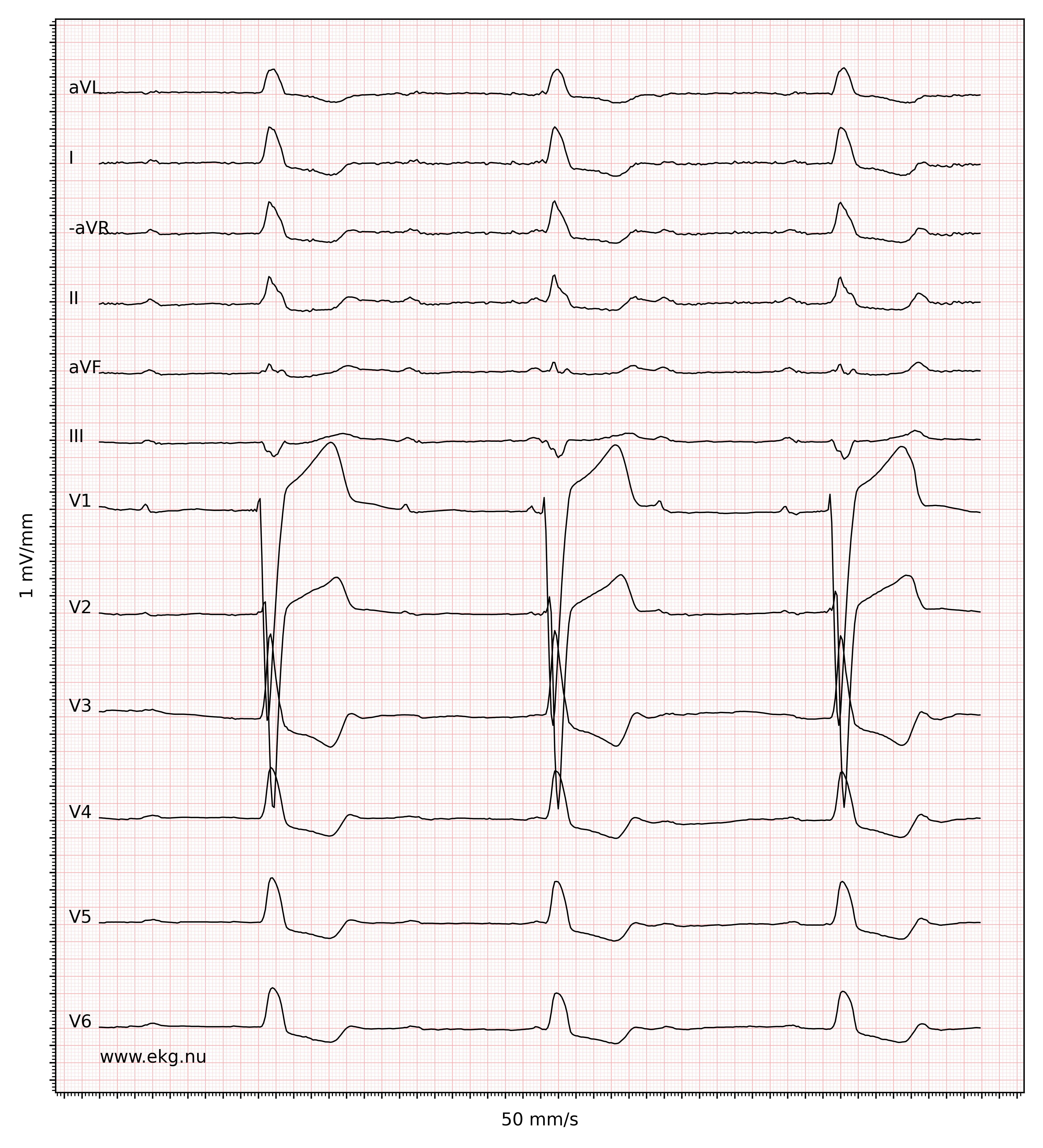 EKG 8619 ecg id 8620 complete left bundle branch block third degree AV block