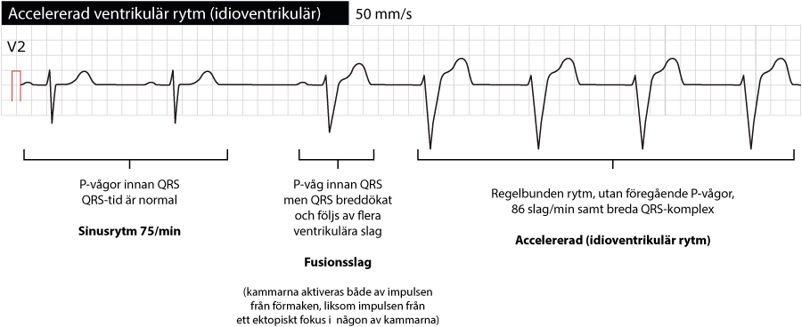 Sinusrytm som följs av ett fusionsslag och sedermera övergår i accelererad (idioventrikulär) rytm.