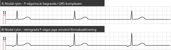 Figur 51. Två varianter av nodal rytm. 50 mm/s (hjärtfrekvens 46 slag/min).