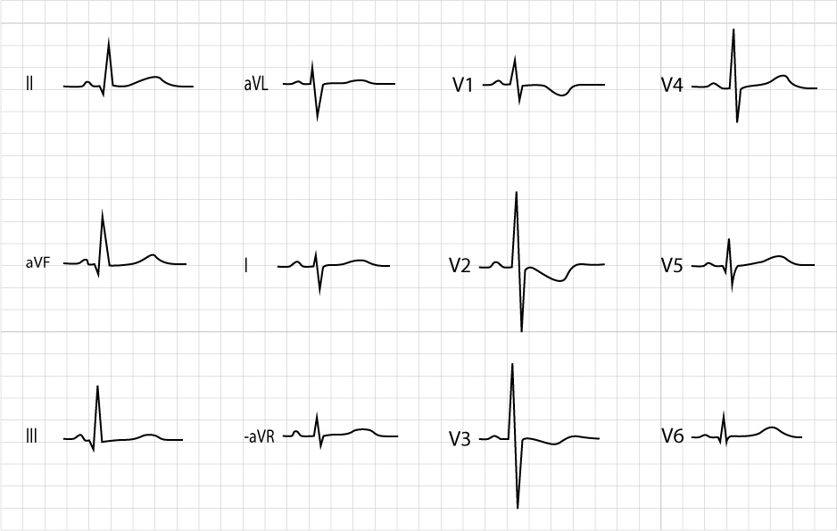 Figur 1. Normalt EKG 8 dagar gammal flicka. Notera att el-axeln är högerförskjuten (negativt QRS i avledning I och positivt QRS i avledning II). R-vågorna är höga i V1–V3, där också negativa T-vågor ses. Det ses Q-vågor infernot (II, aVF, III) och lateralt (V5, V6). Detta är ett helt normalt EKG för barnets ålder.