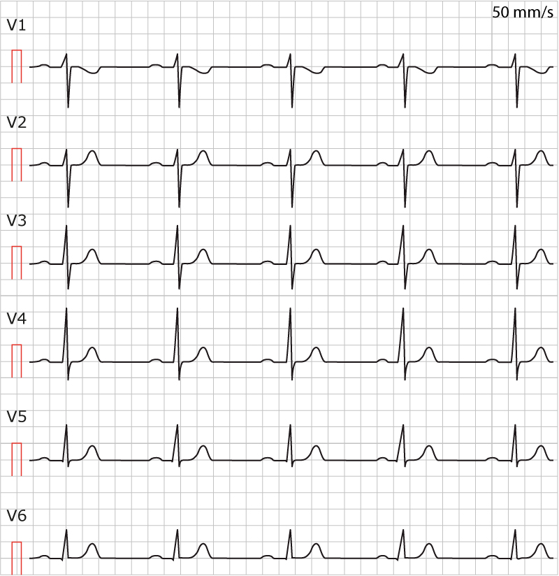 Figur 9. Kort QT-syndrom (Short QT syndrom, SQTS). EKG från 16 år flicka vars mor avled i plötsligt hjärtdöd. QT-tiden är ca 250 ms.