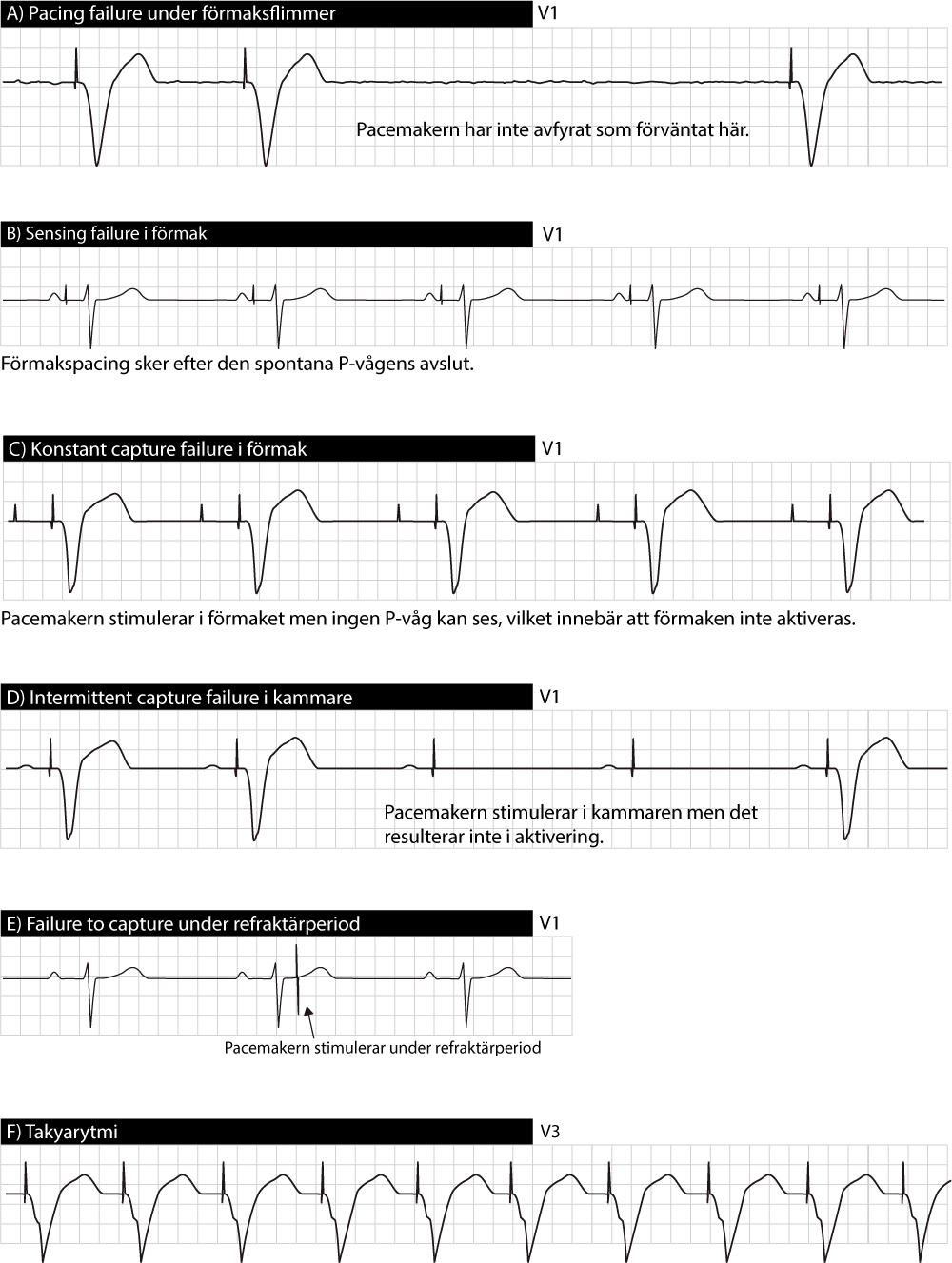 Pacemaker EKG.