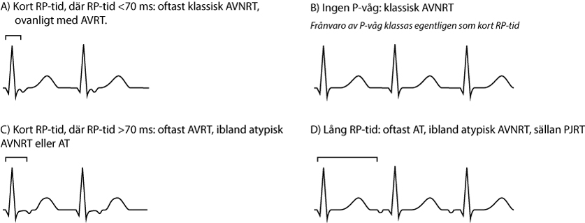 Figur 59. Differentialdiagnoser baserat på RP-tid.