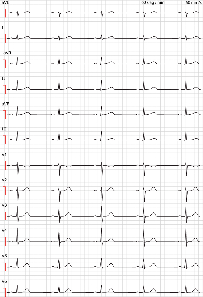 Figur 38. Sinusrytm. Normalt EKG i övrigt.